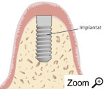 Implantation der künstlichen Zahnwurzel