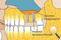 Sinuslift-Knochenaufbau
