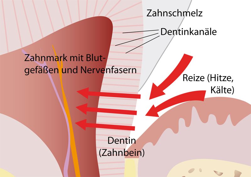 Wie Kommt Es Zu Den Schmerzen? - Zahnarzt-Praxis Ludwigshafen, Prof. Dr ...