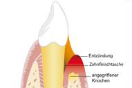 Parodontitis Darstellung