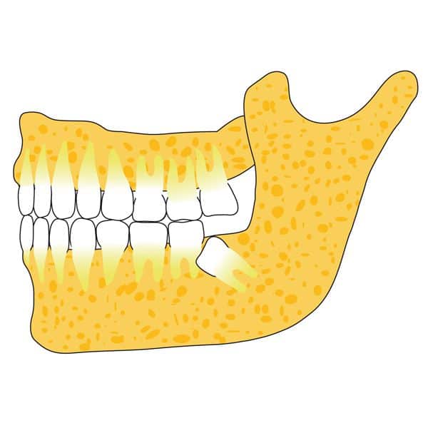 Weisheitszähne