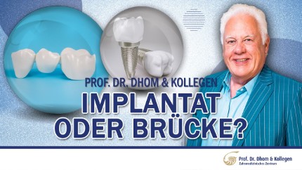 Implantat oder Brücke - Was ist wann besser?